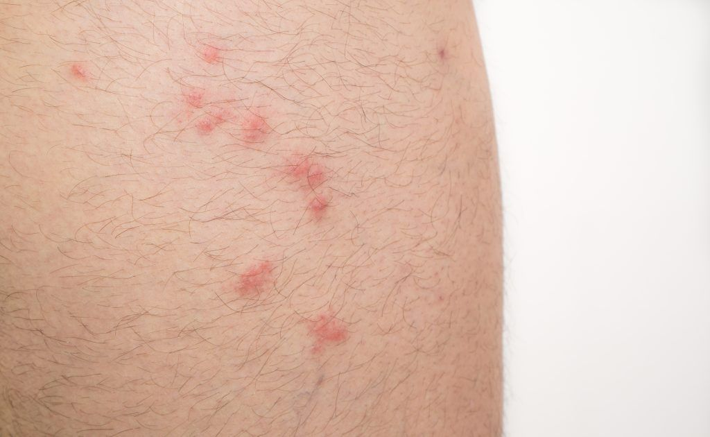 flea bites 1024x630